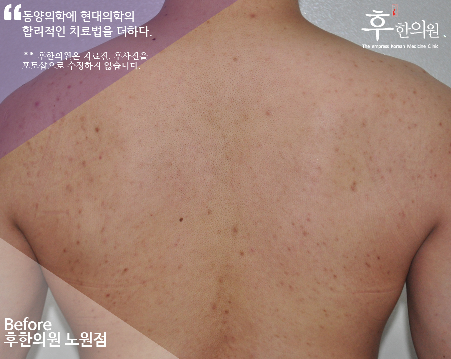 치료 전