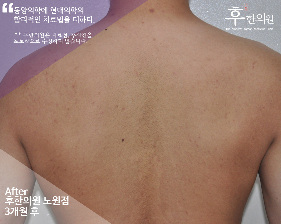 치료 후