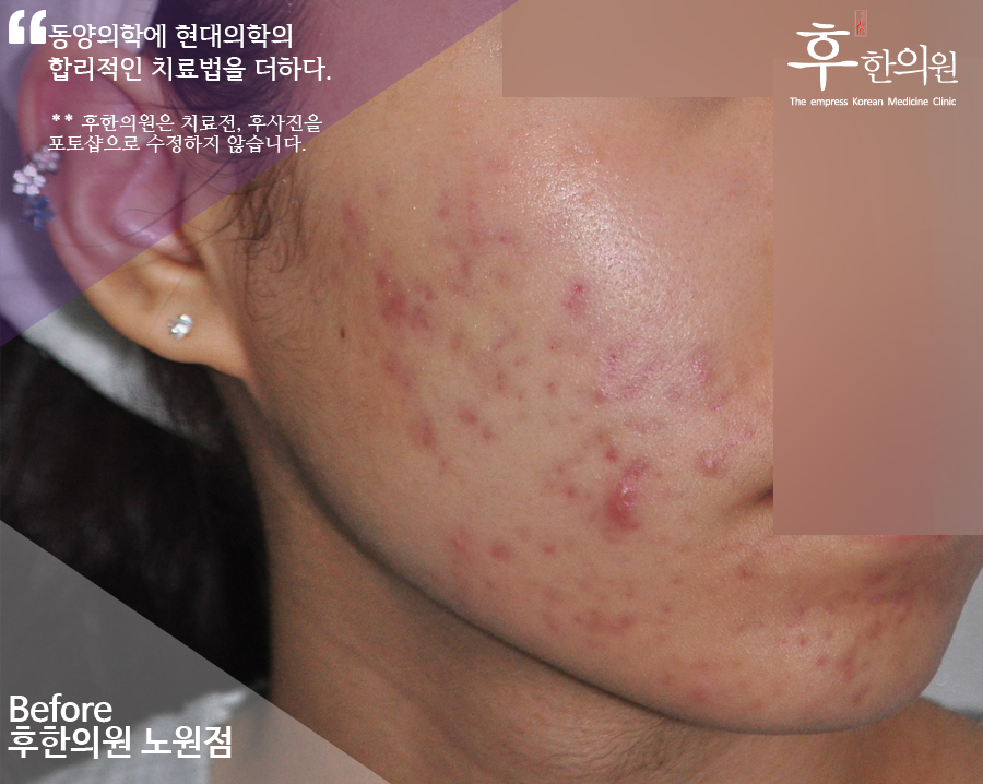 치료 전