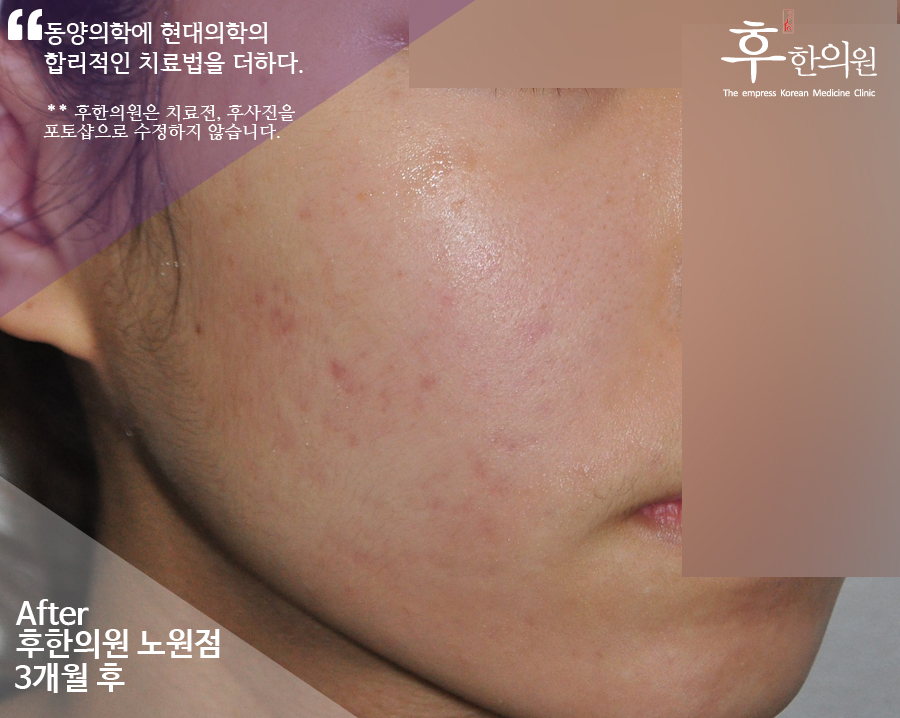 치료 후