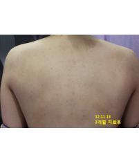 치료 후