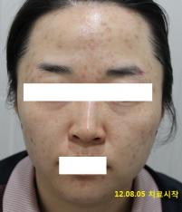 치료 전