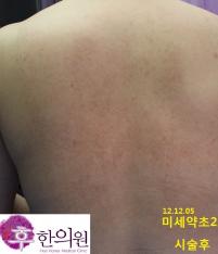 치료 후