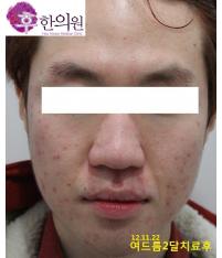 치료 후