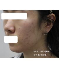 치료 후