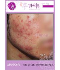 치료 전