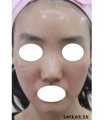 치료 후