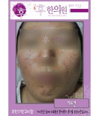 치료 전