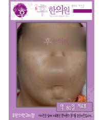 치료 후