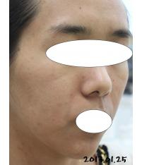 치료 후