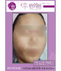 치료 후