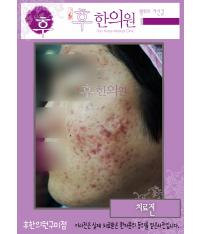 치료 전
