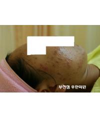 치료 전