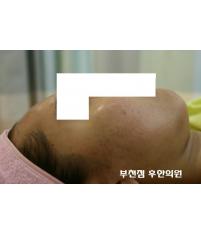 치료 후