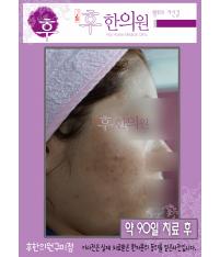 치료 후