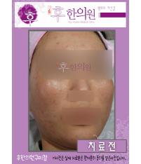 치료 전