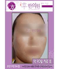 치료 후