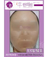 치료 후