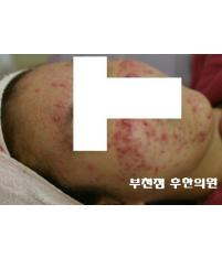 치료 전