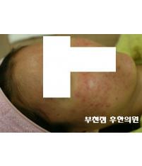 치료 후