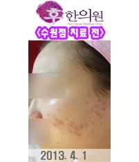 치료 전