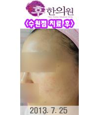 치료 후