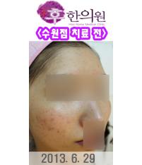 치료 전