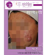 치료 전