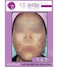 치료 전