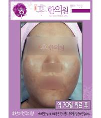 치료 후