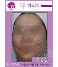 치료 전