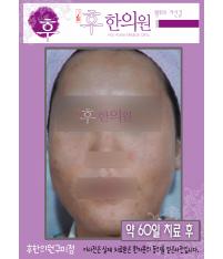 치료 후