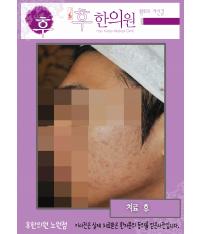 치료 후