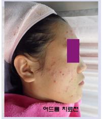 치료 전