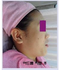 치료 후