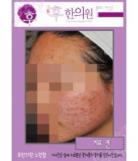 치료 전
