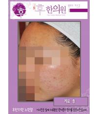 치료 후