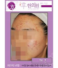 치료 전