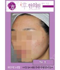 치료 후