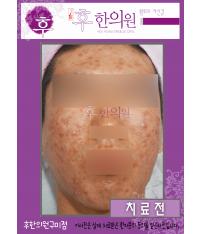 치료 전