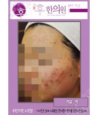 치료 전