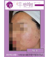 치료 후