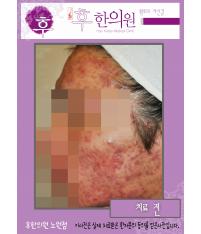 치료 전