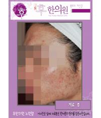 치료 후