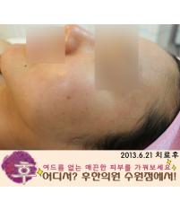 치료 후
