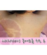 치료 후