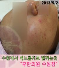 치료 후