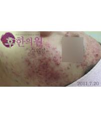 치료 전
