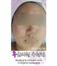 치료 후