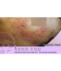 치료 전